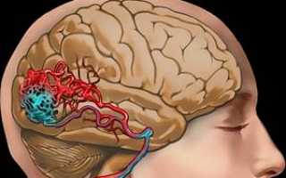Симптомы и лечение сосудистой головной боли