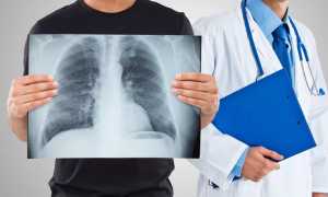 Клиническая картина развития кавернозного туберкулеза легких у взрослых
