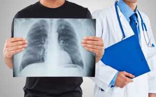 Клиническая картина развития кавернозного туберкулеза легких у взрослых