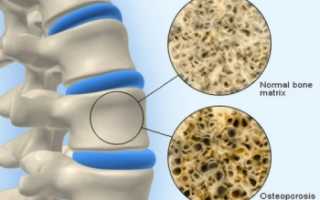Лечение остеопороза в домашних условиях