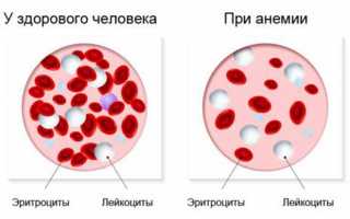 Что значит понижена средняя концентрация гемоглобина в эритроците крови (МСНС)