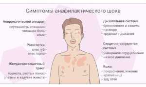 Аллергия на антибиотики: причины появления и пути устранения