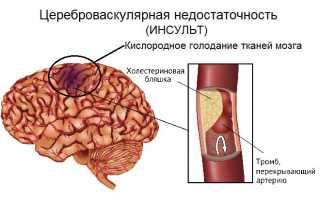 Хроническая цереброваскулярная недостаточность