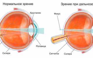 Коррекция зрения при дальнозоркости: методы и их особенности
