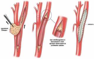 Как лечить (расширить) сужение сосудов головного мозга и какие симптомы стеноза артерий