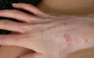 Лечение дерматита на руках народными средствами