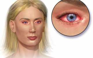 Симптомы и лечение острого конъюнктивита глаз