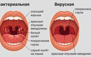 Гнойная ангина у ребенка