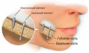 Базальная имплантация — преимущества