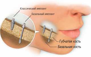Базальная имплантация — преимущества