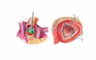 Как лечить стеноз аортального клапана без операции и какие симптомы сужения устья аорты сердца