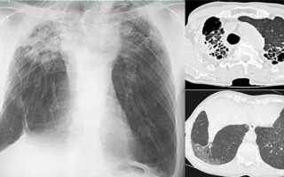 Клиническая картина протекания фиброзно-кавернозного туберкулеза легких