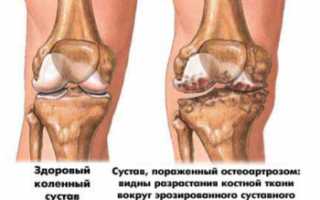 Остеоартроз. Лечение народными средствами