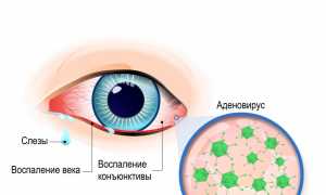 Аденовирусная инфекция