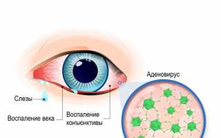 Аденовирусная инфекция