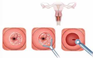 Что делать при кровотечении после биопсии шейки матки и сколько дней идет кровь (кровит)