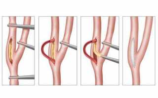 Операция по удалению холестериновых бляшек на сонной артерии при атеросклерозе