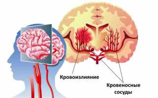 Как лечить геморрагический инсульт головного мозга и симптомы (последствия) внутримозгового кровоизлияния