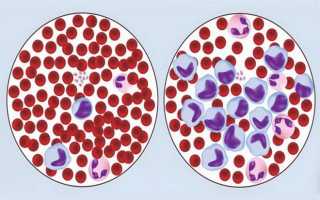 Сколько живут (продолжительность жизни) с хроническим В-клеточным лимфолейкозом (лимфоцитарным)