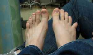 Как определить перелом пальца на ноге