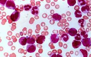 Сколько живут при остром лейкозе крови (лейкемии) взрослые