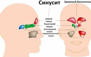 Синусит у взрослых: лечение, признаки, препараты.