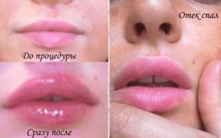 Причины появления синяков после увеличения губ