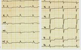 Как выглядит ишемия миокарда на ЭКГ и какие признаки ишемической болезни сердца (ИБС)