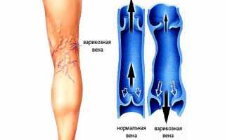 Как лечить хроническую венозную недостаточность нижних конечностей и какие симптомы ХВН 1 (2) степени
