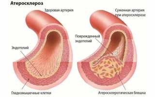 Как лечить атеросклероз сосудов нижних конечностей