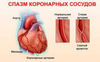 Симптомы спазма коронарных сосудов (артерий) сердца