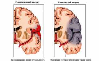 Какие симптомы кровоизлияний в головной мозг у новорожденных детей и возможные последствия