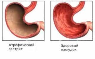 Лечение атрофического гастрита народными средствами