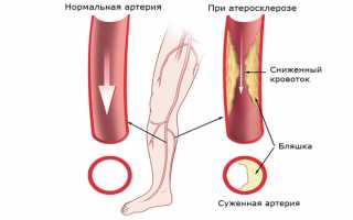 Как лечить заболевание периферических артерий (сосудов) и какие симптомы болезни вен