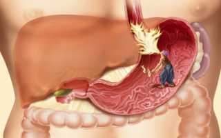 Симптомы атрофического гастрита и самые эффективные народные средства для лечения