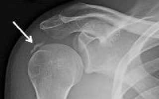 Перелом большого бугорка плечевой кости