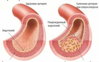 Атеросклероз сосудов нижних конечностей: лечение народными средствами