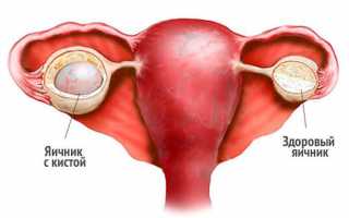 Что делать и как остановить кровотечение при кисте (поликистозе) яичника