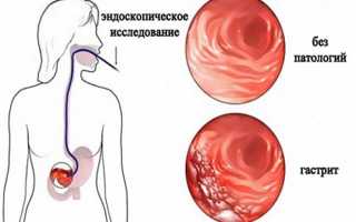 Виды и разновидности гастрита желудка