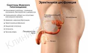 Эректильная дисфункция