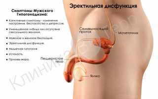 Эректильная дисфункция