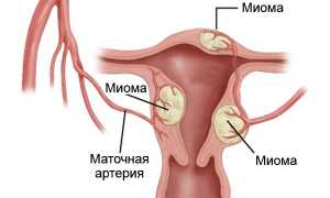 Миома матки