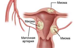 Миома матки