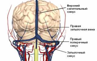 Симптомы и лечение тромбоза венозного (поперечного) синуса головного мозга