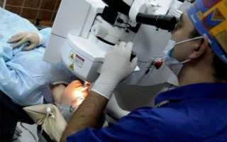 Лазерная операция на глаза: преимущества, последствия и отзывы