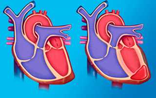 Как лечить аневризму аорты сердца (расширение сосудов) и прогноз после инфаркта миокарда