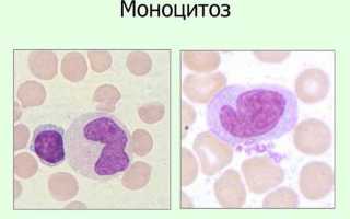 О чем говорят повышены моноциты в крови у взрослого (моноцитоз)