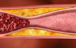 Чем чистить сосуды от холестериновых бляшек