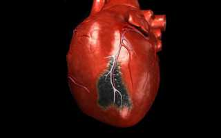 Как распознать симптомы и первые признаки (предвестники) инфаркта миокарда