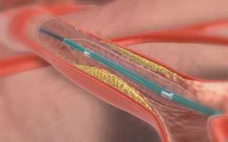 Как проводят баллонную и коронарную ангиопластику сосудов (артерий) сердца